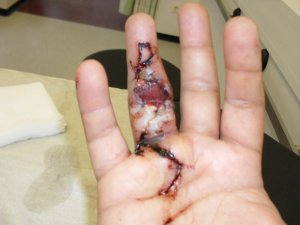Finger 3  OP 1  02.08.2012.JPG
